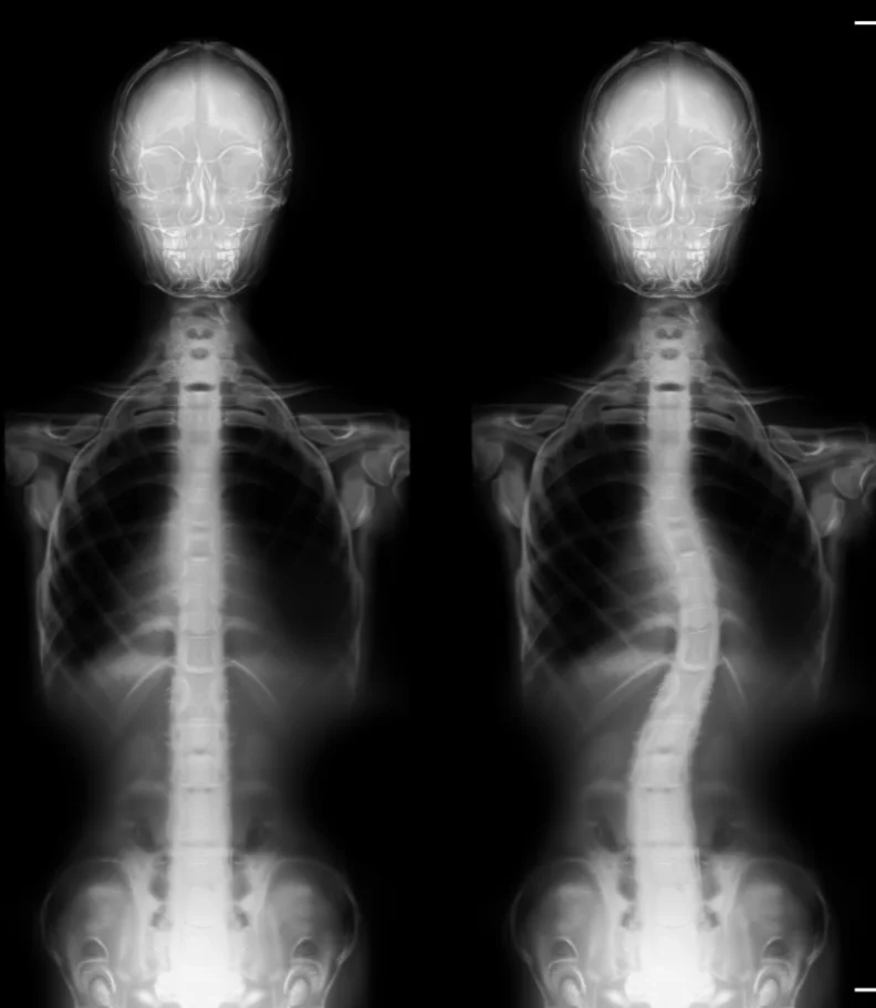 Scoliosis Kalamazoo
